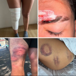Imágenes de las heridas provocadas por las cargas policiales.